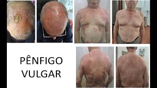 Fernando - Pênfigo Vulgar