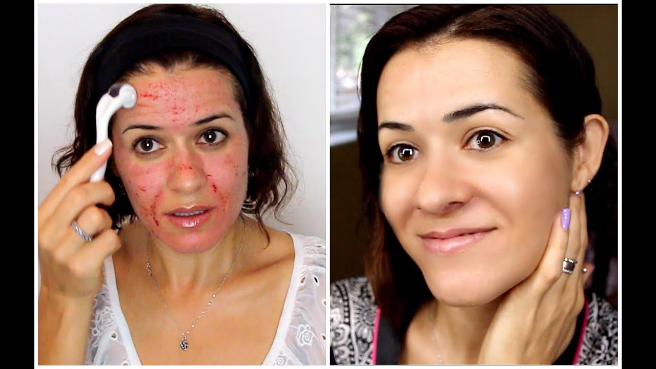 Fotos de cirurgia das palpebras antes e depois 52 Fotos de cirurgia das palpebras antes e depois 34