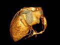 Multiple Giant Coronary Artery Aneurysms Due to Kawasaki Disease: Electrocardiogram-Gated 64-Slice