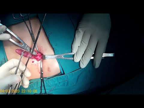 Open appendectomy procedure การผ่าตัดไส้ติ่งอักเสบเฉียบพลันแบบแผลเปิด