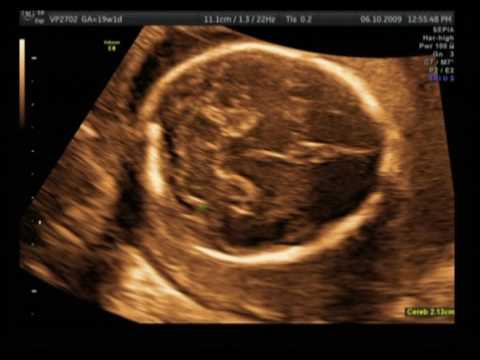 Scans Of Twins. Twins 19 week Ultrasound Scan