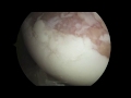 Shoulder Labral Repair