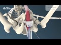 AMI ATOMS - Adjustable implant to treat male stress urinary incontinence after radical prostatectomy