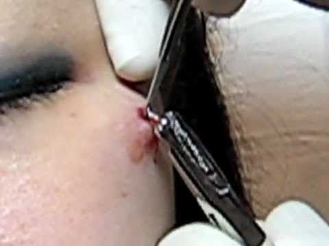 Tags: microdermal removal remove cut out cheek piercings step by dermal 