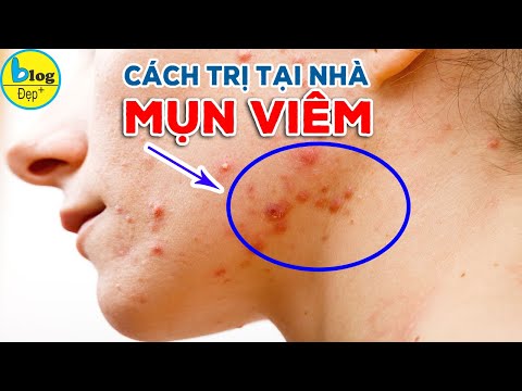 Top 7 cách trị mụn viêm tại nhà đơn giản, hiệu quả nhất