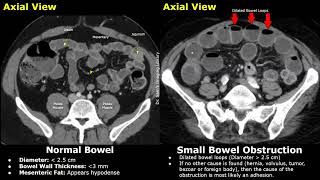 Ct Abdomen Normal Bowel Vs Small Bowel Obstruction Adhesions, Volvulus, Hernia & Other Causes