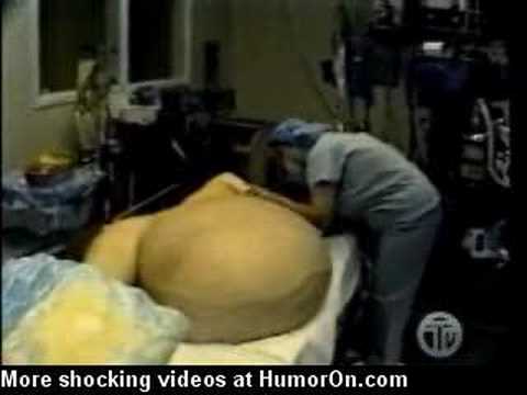 A Woman has a 300 Pound Tumour removed from her Stomach. This is incredible.