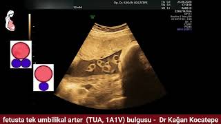 Tek umbilikal arter (TUA), 1A1V nasıl görülür? Bebekte kromozom bozukluğu, gelişim geriliği riski?