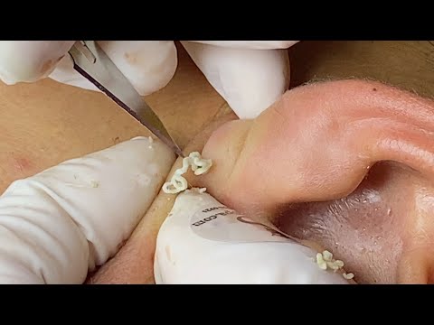 Whiteheads | Mụn Ẩn, Sợi Bả Nhờn SacDepSpa237