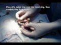 adult circumcision