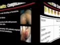 adult circumcision