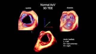 3D Echocardiography Acquisition, Cropping, And Case Examples