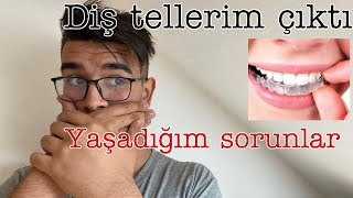 Diş Tellerim Çıktı. Yaşadığım Sorunlar... Ömer Şahin