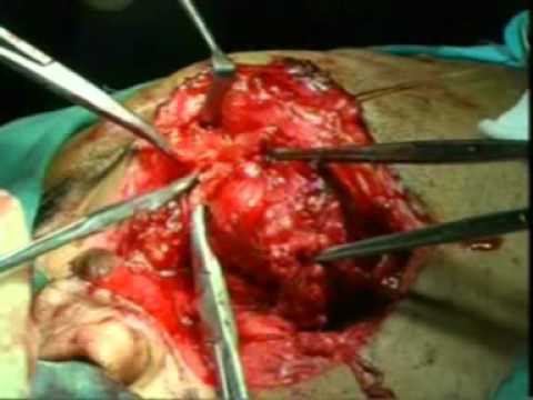 parotidectomy and facial porno girl with tail