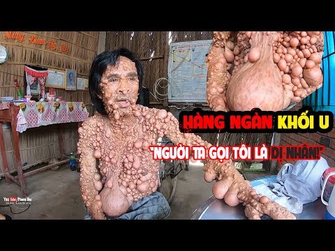Người có hơn 1.000 mụn thịt ở miền Tây | PHONG BỤI