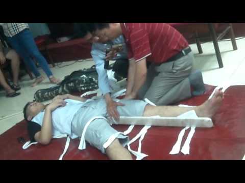 Tập huấn hè 2016: cố định gãy xương đùi.