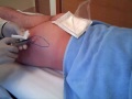 Bioplastia de Nalgas en Marbella.wmv