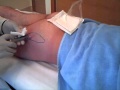 Bioplastia de Nalgas en Marbella.wmv