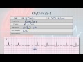 Basic Electropysiology, part 10 - AV Heart Block Rhythms