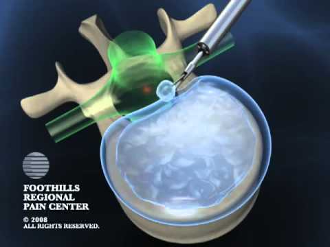 Epidural steroid injection discogenic pain