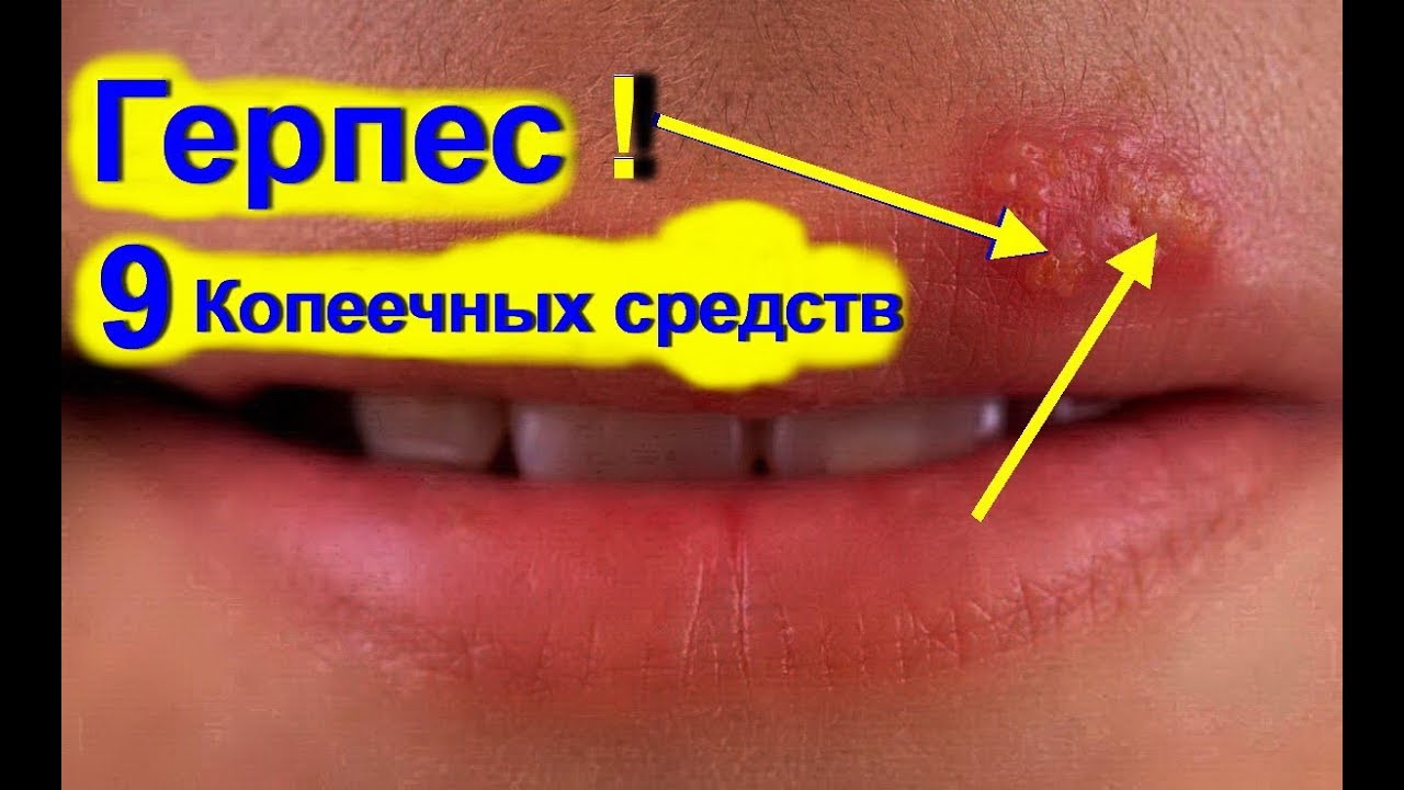 Чем лечат простуду на губах в домашних условиях быстро Чем лечат простуду на губах в домашних условиях быстро