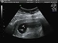 Sonogram (Ultrasound) at 12 weeks pregnant