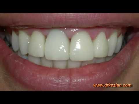 Dental Implants in Los Angeles -s