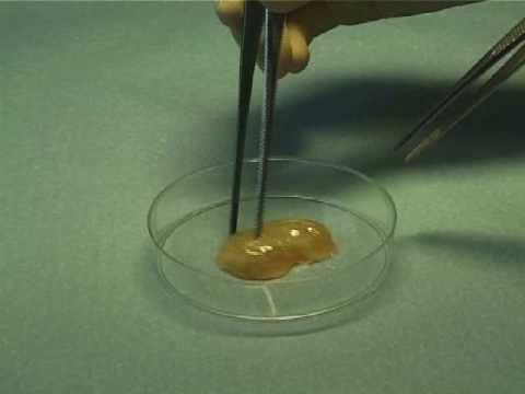 This is a cervical mucus plug shed during normal labor a term of pregnancy.