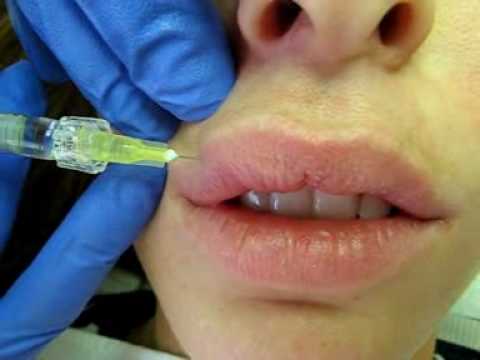 #39;Amsterdam block#39; and Lip. restylane lip injections before and. #39;Amsterdam block#39; and Lip.