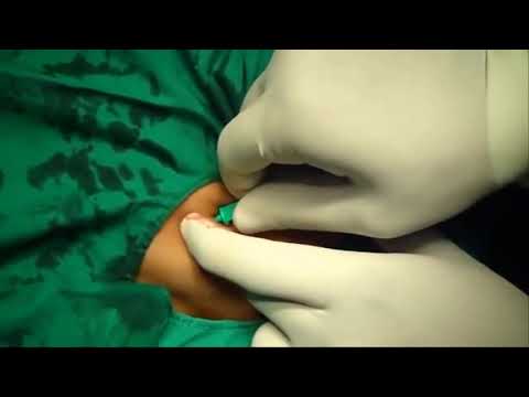 ĐẶT CATHETER TĨNH MẠCH DƯỚI ĐÒN TỪ AZ CÓ MINH HỌA subclavian vein catheter insertion
