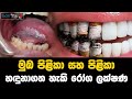 Jeevithayata Idadenna - Oral Cancer
