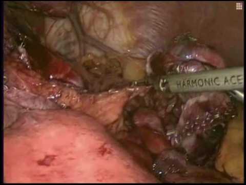 9306GS Laparoscopic Revision of Open Roux-En-Y Gastric Bypass with Fundus 