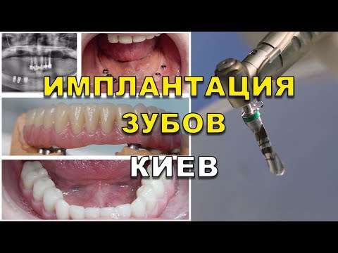 Sportoras Качественная одежда для спорта и фитнеса Имплантация зубов в Киеве