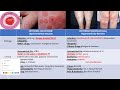 8- ALLERGIC Drug Eruption (PART 2) شرح الجلدية الطفح الدوائي د.عبدالرحمن رضا #2 8- ALLERGIC Drug Eruption (PART 2) شرح الجلدية الطفح الدوائي د.عبدالرحمن رضا #2