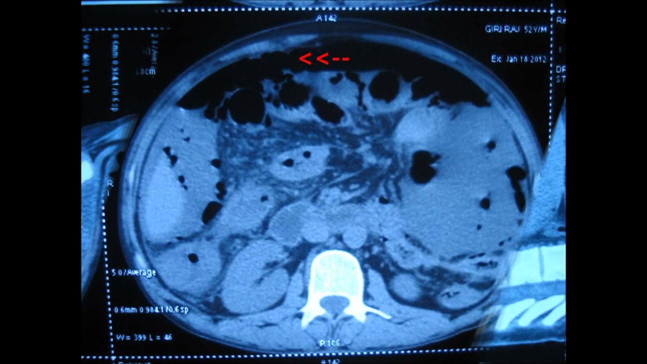 Bowel perforation… CT scan features….. YouTube Bowel perforation… CT scan features….. YouTube