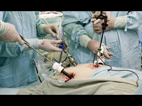 laparoscopic gallbladder surgery cholecystectomy hysterectomy removal procedure remove having
