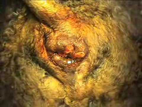 fistula perianal