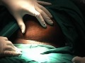 Caesarean Section: Making the abdominal incision