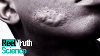 The Man Covered In Boils Mystery Diagnosis Reeltruth