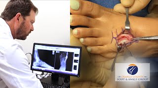 Oc Feet - Podiatry - Foot Tumor Removal Surgery In Orange County - Patient Testimonial