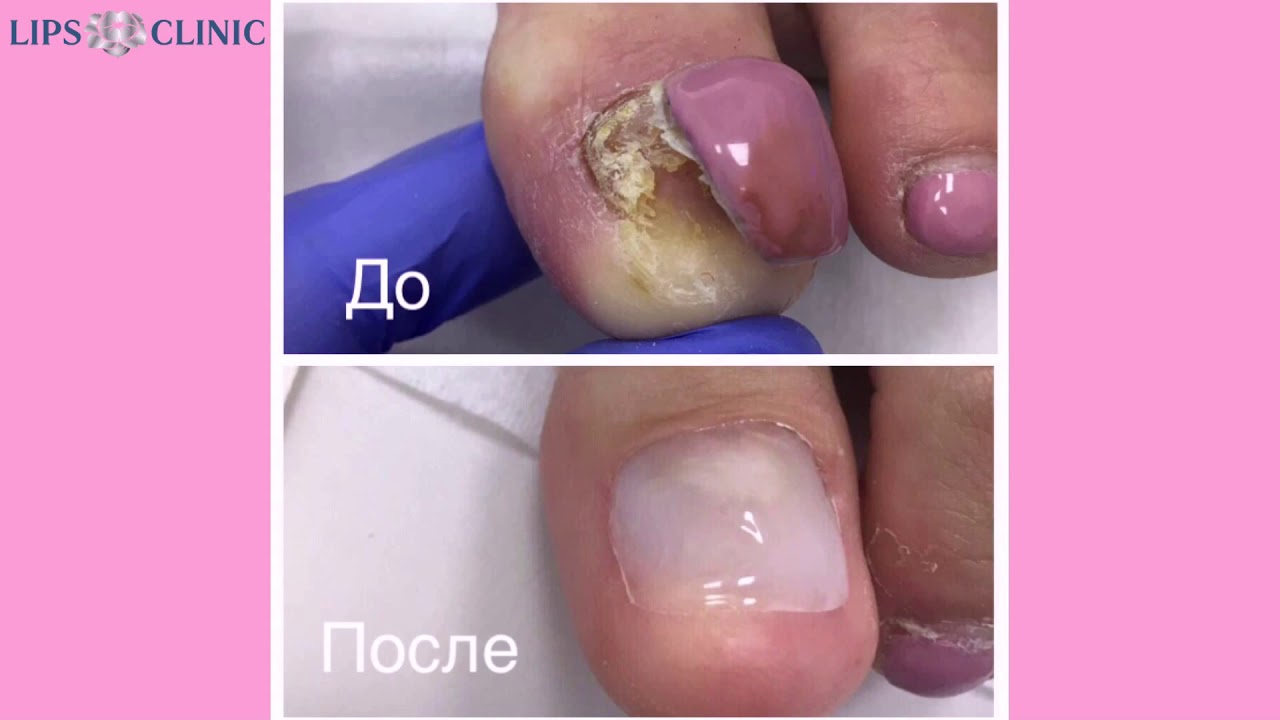 Как протезируют ногти Как протезируют ногти