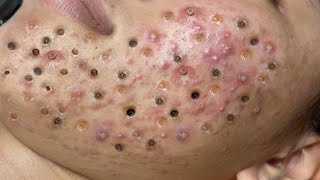Loan Nguyen Acne Treatment 67C