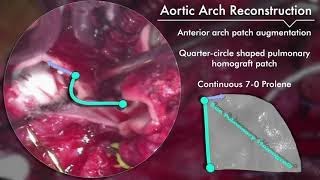 Yasui Procedure with Aberrant Right Subclavian Artery Translocation