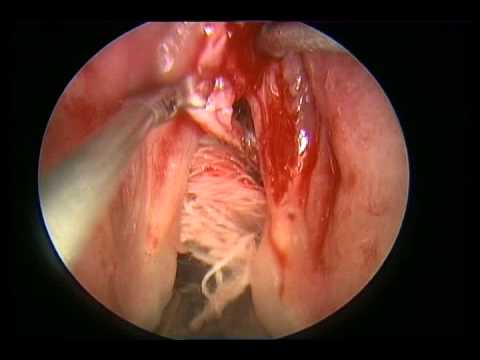 White Patch On Vocal Cord