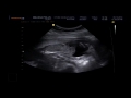 Ultrasound 1 of 3