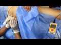 Ultrasound Guided Pns Lumbar Plexus Block Lower Parasacral Sciatic Nerve images Ultrasound Guided Pns Lumbar Plexus Block Lower Parasacral Sciatic Nerve