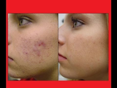 How to Get Rid of Acne Scars Fast and Naturally Overnight 