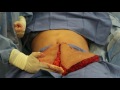 Tummy Tuck Surgery and Liposuction in Houston TX