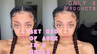 MY SIMPLE SKIN CARE ROUTINE THAT GOT RID OF MY ACNE QUICK (ALL DRUGSTORE)