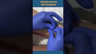 Remoção Correta De Filme Transparente.